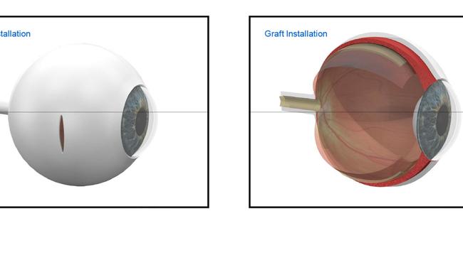 An incision is made in the side of the eye to insert the stem cell patch.