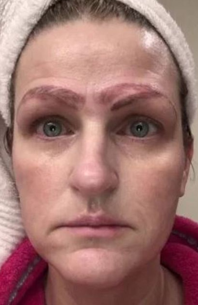 Jami Ledbetter underwent an eyebrow procedure that left her with a result she wouldn’t ‘wish on my worst enemy’. Picture: WDAF