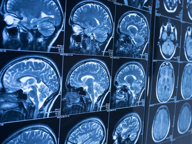 An estimated 1924 Australians were diagnosed with some form of brain cancer in 2023.