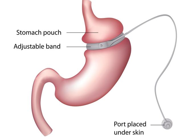 An adjustable gastric band or lap band.