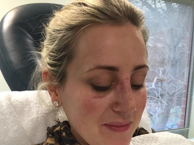 First reveal... Roxy Jacenko’s nose cast is taken off