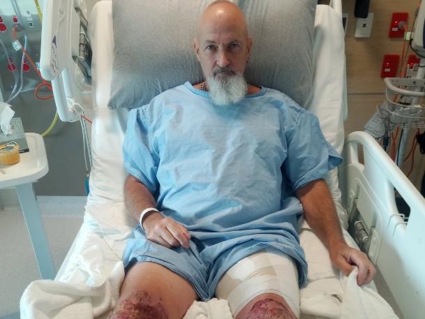 Gregory Orr of Crystal Brook in the RAH Burns Unit after suffering severe leg burns from wet cement. Picture Gregory Orr