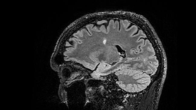 Former Newcastle Knight Robbie O'Davies' MRI in 2023. The white spot on the MRI is scarring.