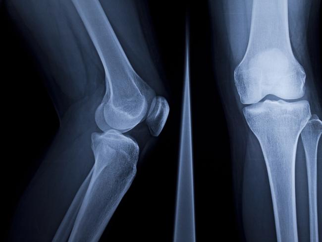 X-Ray of human knee  Picture: istock