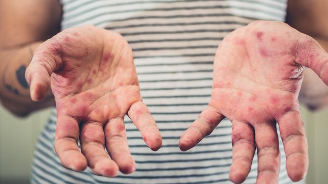 Territorians are being urged to get vaccinated now if they aren’t already PIC: ISTOCK