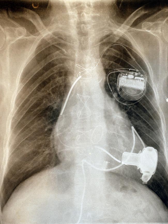 X-ray of Jack's chest showing LVAD pump (bottom) and defibrillator (top).