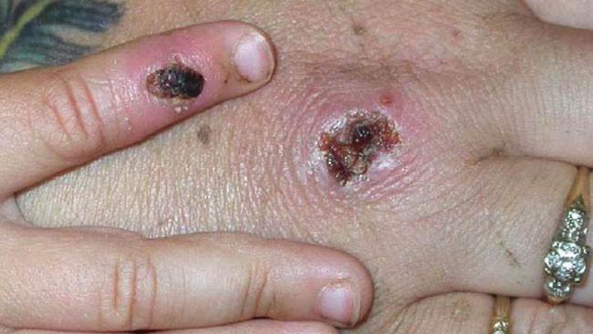 A man in his 50s who recently travelled to the Whitsunday has tested positive for monkeypox. (Photo Courtesy of CDC/Getty Images)