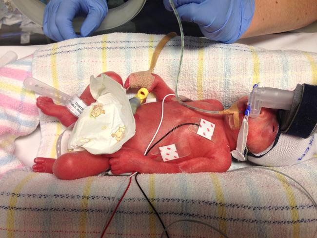 Premature baby, Isabelle Constable. She was born at 27 weeks and weighed 970g. Picture: Supplied