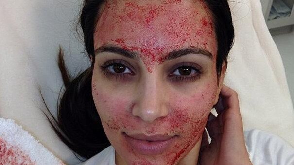 Kim Kardashian was one of the first celebrities to try the “blood facial”. Picture: Instagram