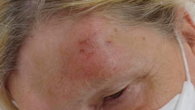 Victorian grandmother Sandi Galloway was bitten by a flying fox in the Cairns CBD while on holiday with her partner. Australian bats carry the potentially fatal lyssavirus disease which has previously killed three Queenslanders. Picture: Supplied.