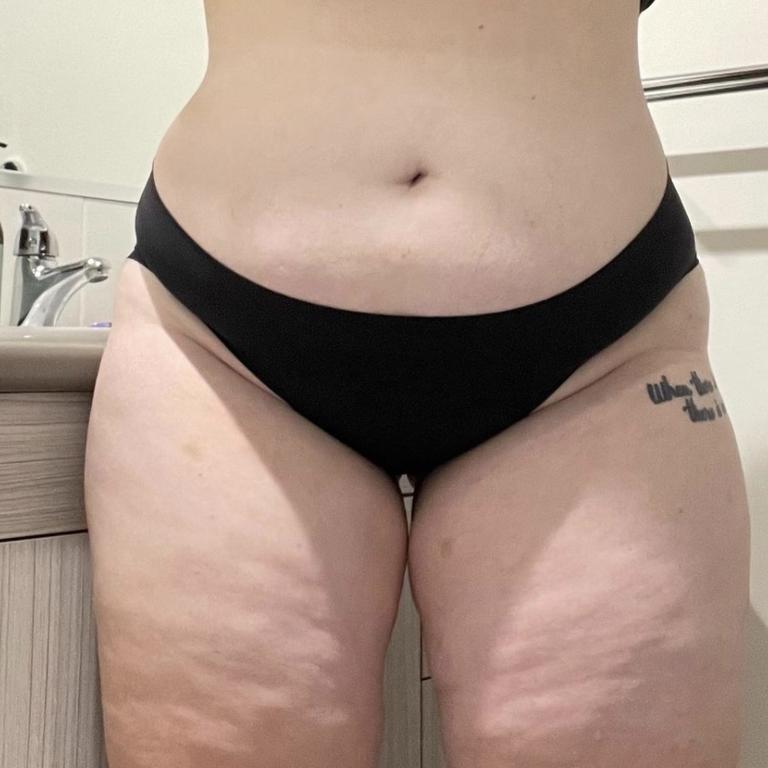 Lipoedema symptoms: Queensland woman reveals why she couldn't lose