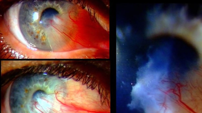 Pterygium, otherwise known as “surfer’s eye”. Picture: Supplied