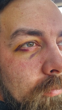 Assault victim demands action on coward punch laws