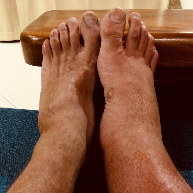 Lee Carseldine's infected leg after he was bitten by a spider on Australian Survivor All Stars. Picture: Supplied.