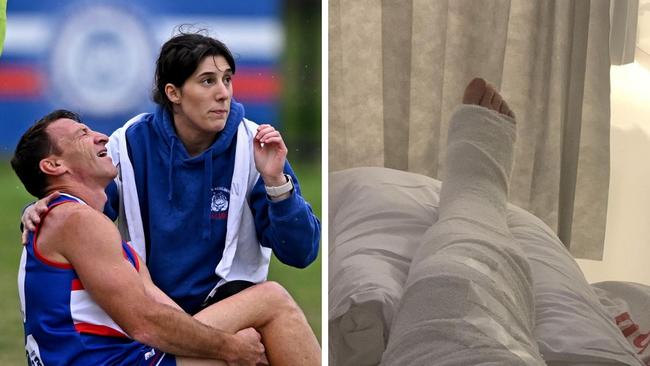 Former North Melbourne Kangaroos player Brent Harvey with his broken leg from a local footy fixture.