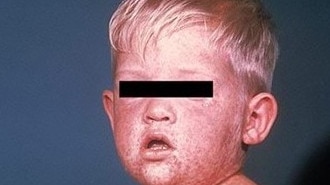 Symptoms to watch out for include fever, runny nose, sore eyes and a cough, usually followed three or four days later by a red, blotchy rash that spreads from the head to the rest of the body. Picture: Victoria Department of Health