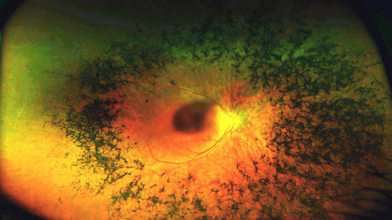 This is what a diseased retina looks like.