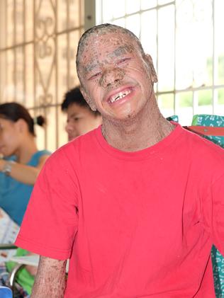 Nguyen Minh Anh, aged 21, born with ichthyosis (thought to be unrelated to Agent Orange) and mental illness (his scaly skin led him to be nicknamed Ca, the Vietnamese word for ‘fish’). Photo: Ash Anand / NEWSMODO