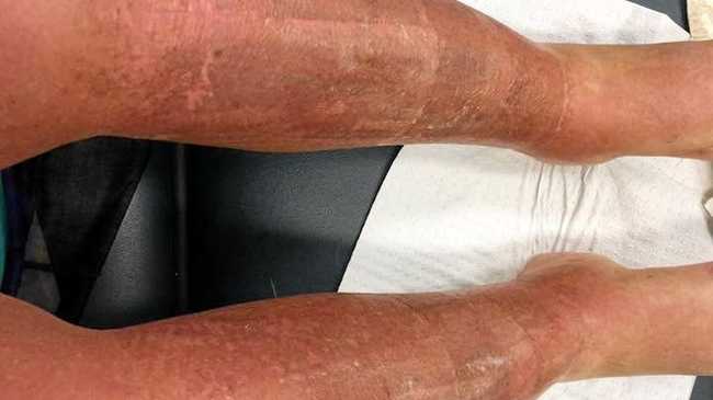 Woman suffers third degree burns from the sun | Daily Telegraph