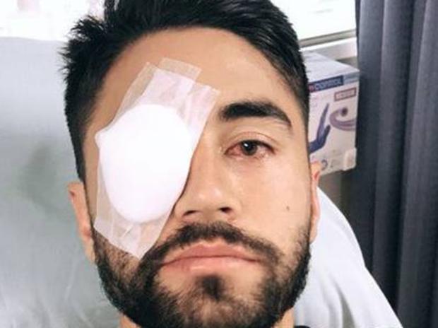 Shaun Johnson had surgery to remove a benign growth on the surface of his eye.