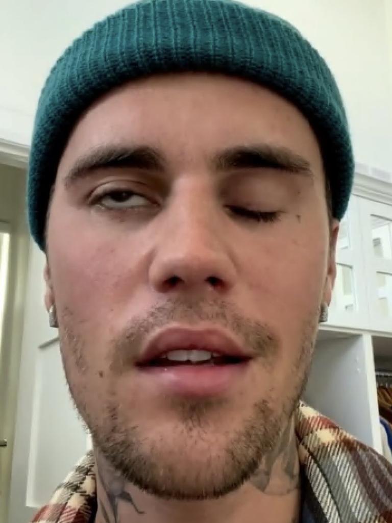 Justin Bieber told fans about his facial paralysis over the weekend.