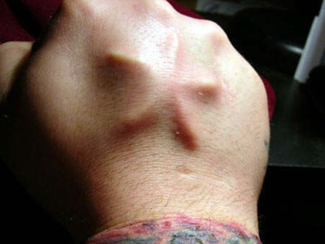 A star implanted into a man’s hand, similar to the procedure the woman allegedly had.