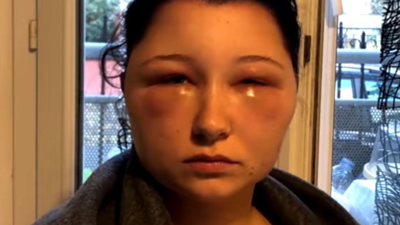 Woman has near fatal allergic reaction to hair dye: head swells to huge ...