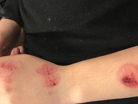 The waiter shows off his injuries after he was allegedly bitten by Quan after a dispute at the Nice Fish Chinese Restaurant. Picture: Supplied