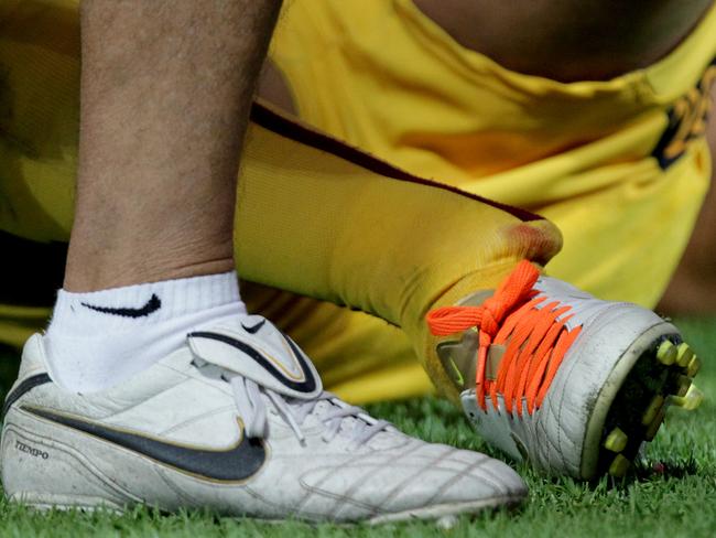 The horrific ankle injury suffered by Yow Yeh during the March 2012 Broncos v Rabbitohs match in Perth. 