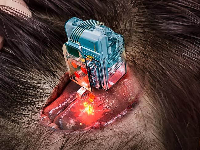 Elon Musk’s start-up Neuralink on Thursday said it has approval from US regulators to test its brain implants in people.