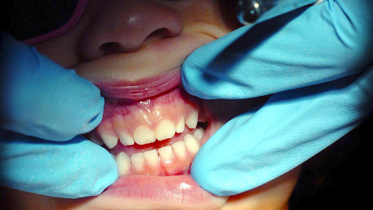 Fluoride varnish can be applied by a dentist or health practitioner.