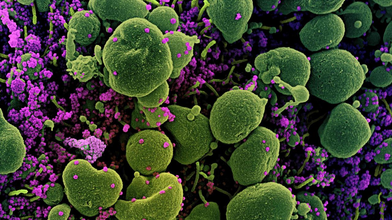 A colorised scanning electron micrograph of an apoptotic cell (green) heavily infected with SARS-CoV-2 virus particles (purple). Picture: AFP