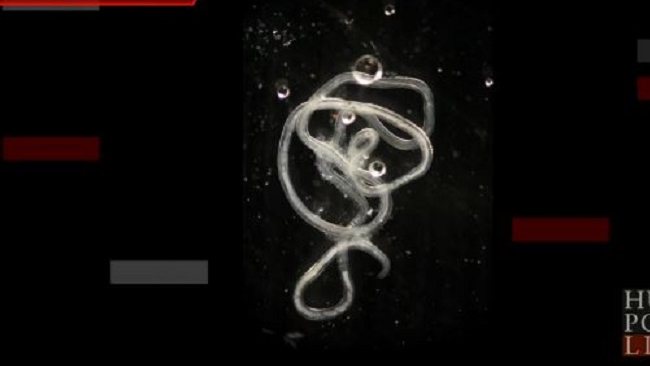 An image of the parasitic worm 'gongylonema pulchruma', after it was removed from Mr Allen's mouth. The creature usually lives in livestock, and Mr Allen's case is only the 13th in the US. Picture: Supplied