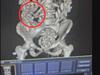 Horror find in tourist’s stomach