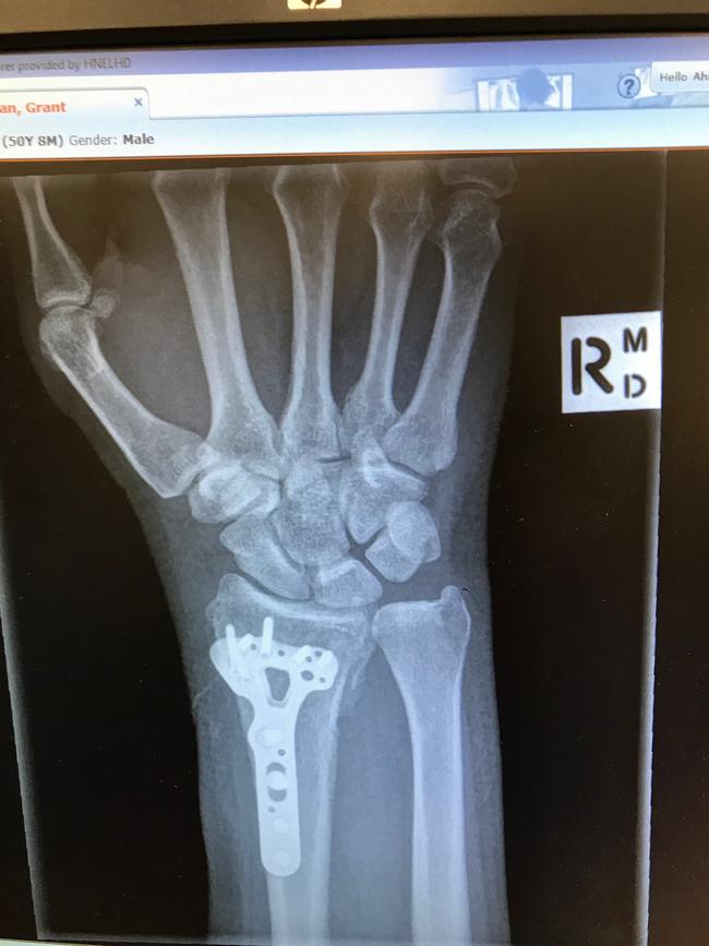 Grant Callaghan broke his wrist.