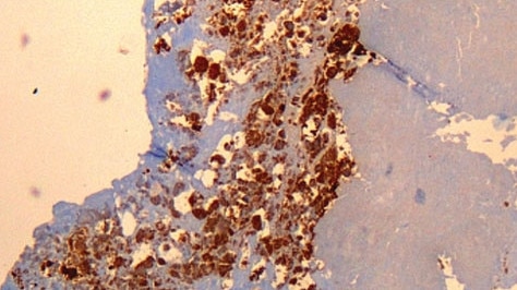 Q fever or query fever is a disease caused by infection with Coxiella burnetii,a bacterium that affects humans and other animals. This organism is uncommon, but may be found in cattle, sheep, goats, and other domestic mammals, including cats and dogs.  Immunohistochemical detection of C. burnetii in resected cardiac valve of a 60-year-old man with Q fever endocarditis, Cayenne, French Guiana. Picture: Wikipedia