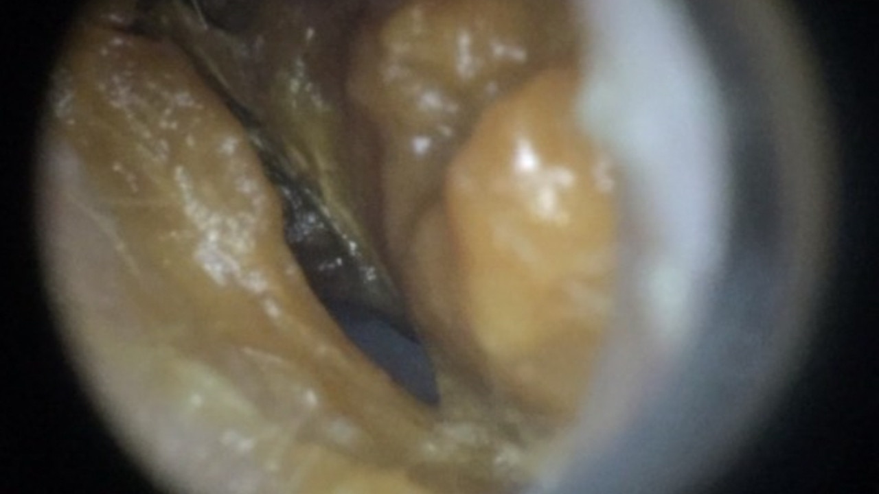 An extreme close up of a build-up of ear wax inside someone’s ear canal. It’s the yellowy brown stuff. Picture: supplied