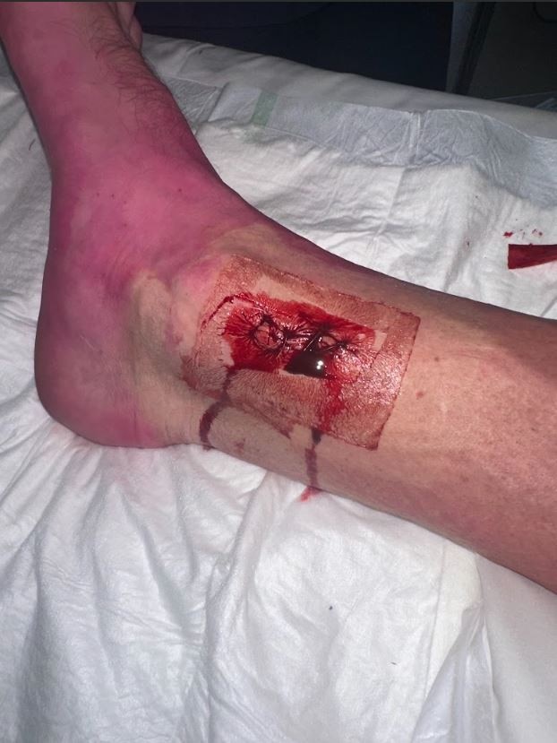 Walker required pins inserted into his ankle after the accident.