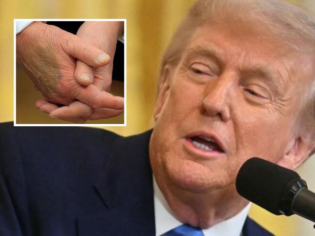 Speculation mounts about marks on Donald Trump's hand. Picture: Getty.