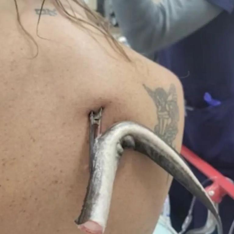 The barb dug deep into Cataffo-Obrien’s back, missing her lungs by just inches.