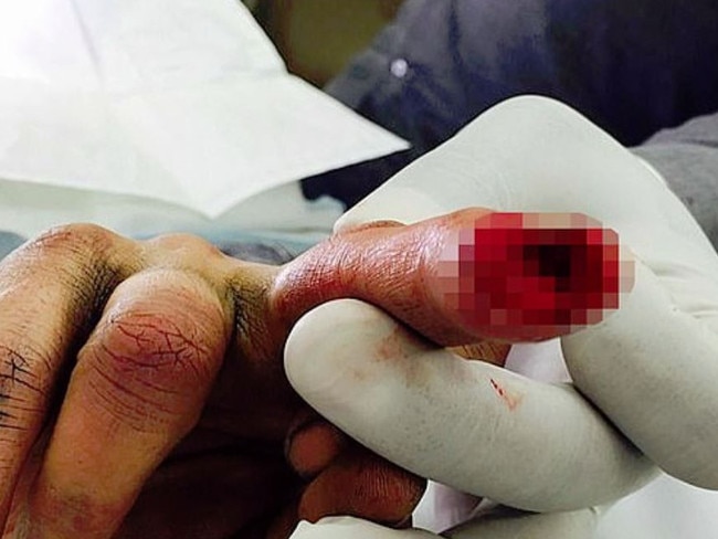 A photo of Johnny Depp’s injured finger was tendered to the court last week.