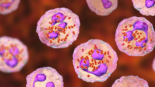 Meningococcal meningitis, cerebrospinal fluid smear containing neutrophils with and without bacteria Neisseria meningitidis, 3D illustration