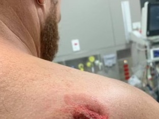 Bite marks are seen on the shoulder of a man who the Health Services Union said was injured at Port Macquarie Base Hospital. Supplied via NCA NewsWire.