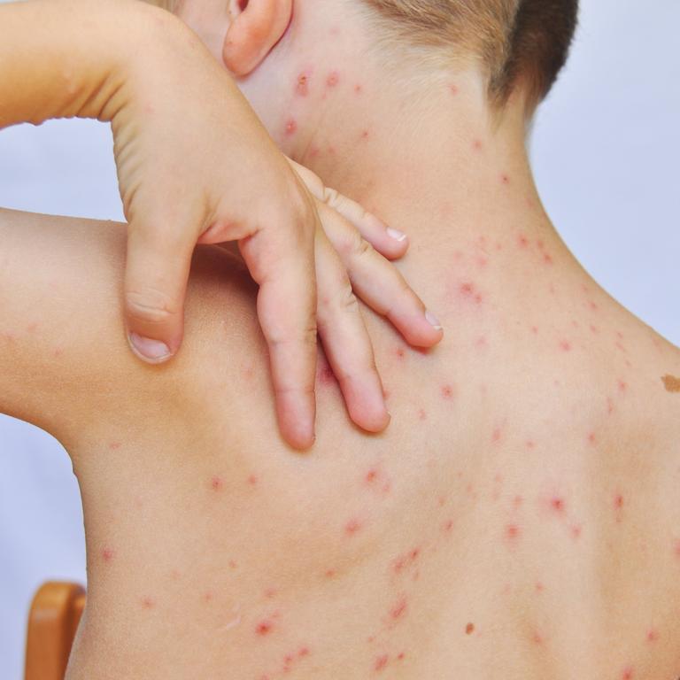 Queensland has seen a surge in chickenpox cases among children.