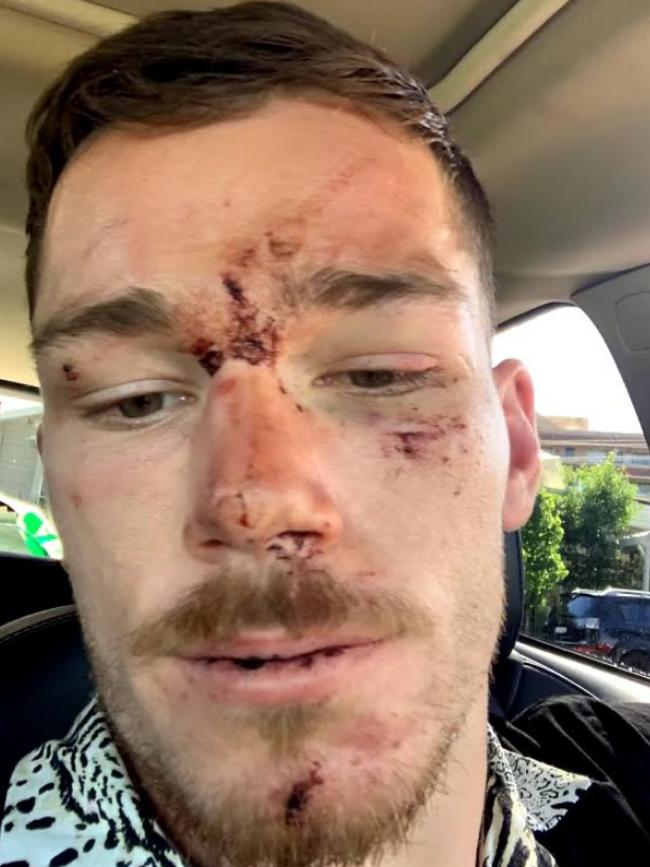 The Canberra Raiders hooker posted images of his injuries after the brawl.