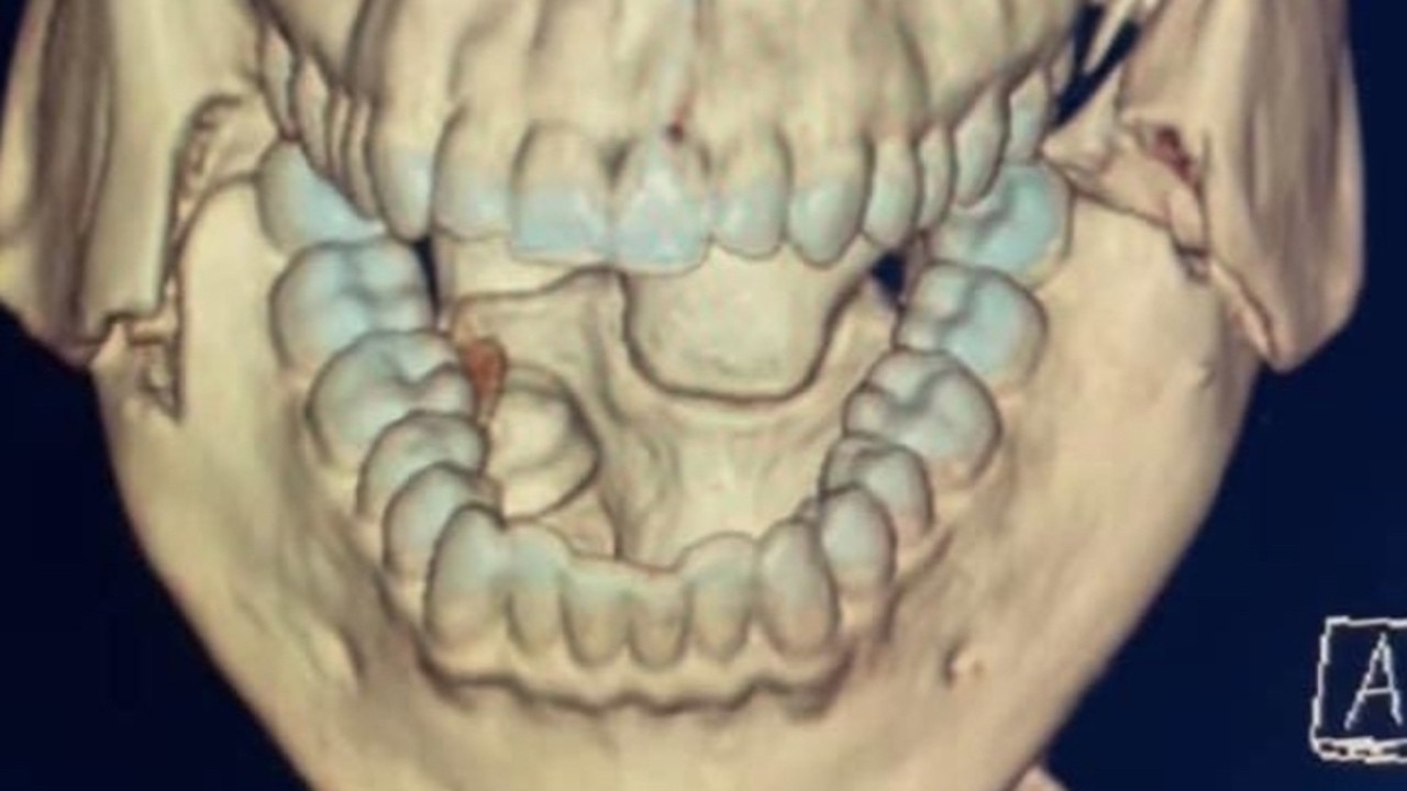 X-ray image of Jai Opetaia’s face shows two cracks to either side of his jawline.