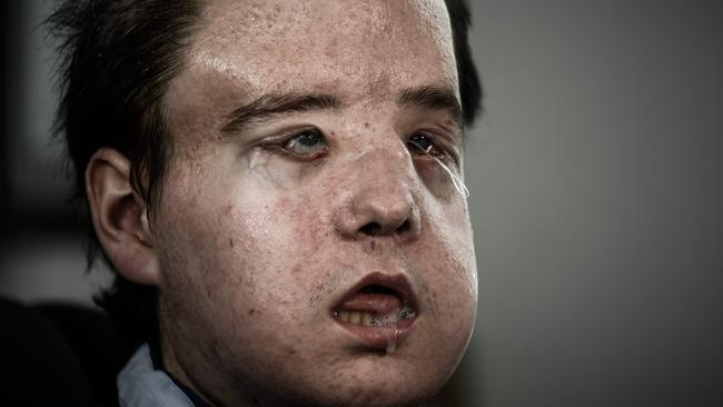 Jerome Hamon was the first man in the world to twice undergo a face transplant after flu tablets incompatible with his anti-rejection treatment led to the first attempt to fail.