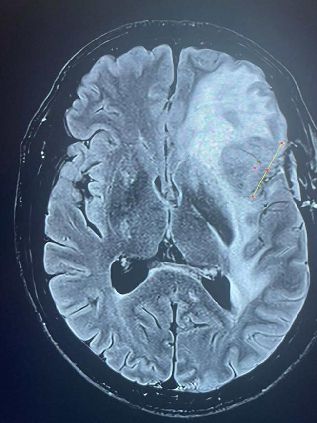 A recent MRI scan of his brain shows progression of the cancer. Picture: Instagram