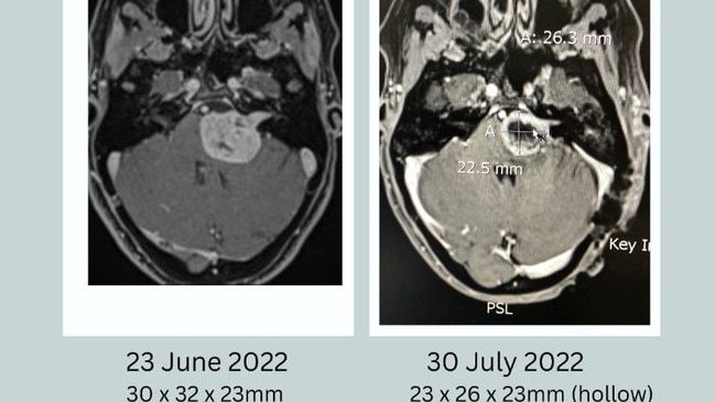 Catherine Mundy's brain scans. Picture – contributed.