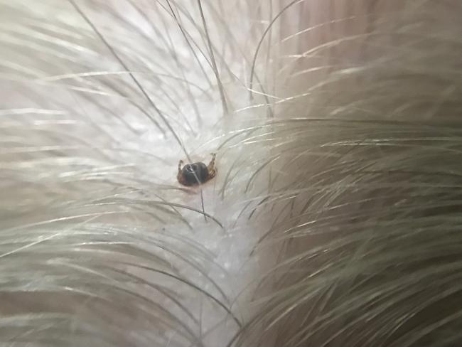 A tick embedded in the head of a boy from Sydney's northern beaches.